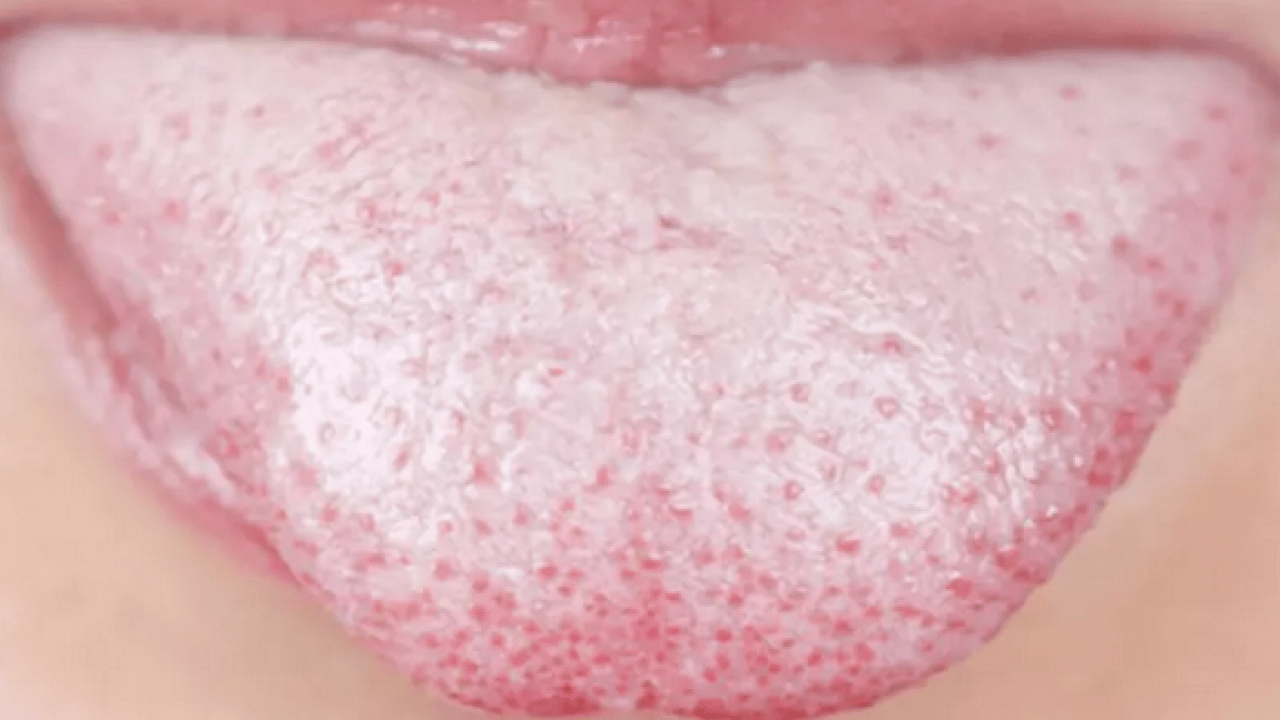 Foto - Beyaz bir dilin mi var? Bu hangi hastalıklara işaret ediyor? Bu rahatsızlık muazzam bir risk, uzmanı işaret etti!