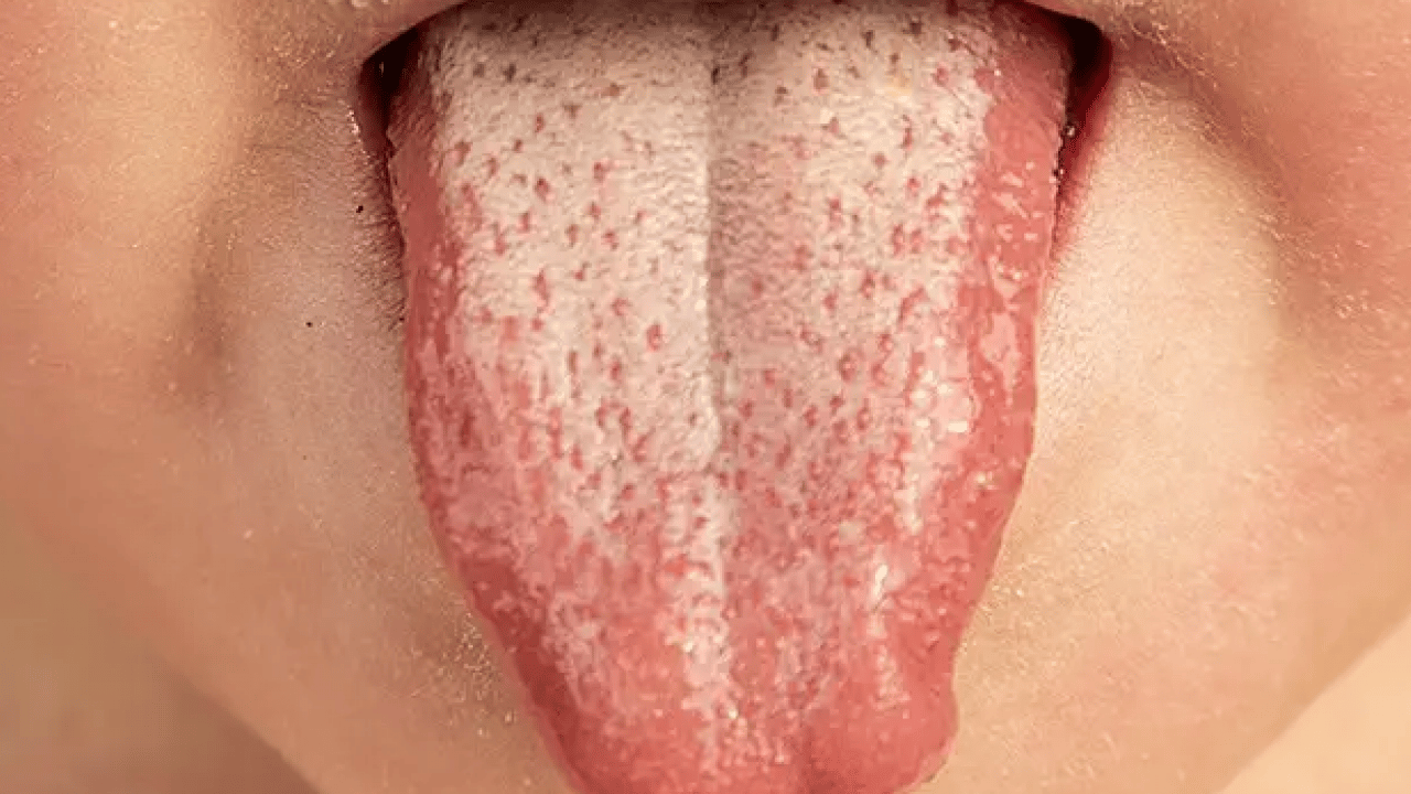 Foto - Beyaz bir dilin mi var? Bu hangi hastalıklara işaret ediyor? Bu rahatsızlık muazzam bir risk, uzmanı işaret etti!