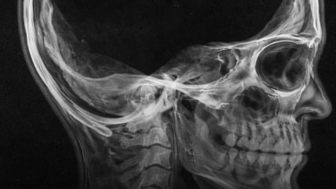 Foto - Beyin kütlesinin %90'ı eksik olan bir adam keşfedildi: Buna rağmen... Büyük şok etkisi!