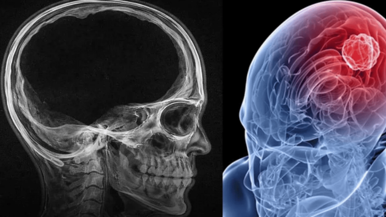 Foto - Beyin kütlesinin %90'ı eksik olan bir adam keşfedildi: Buna rağmen... Büyük şok etkisi!