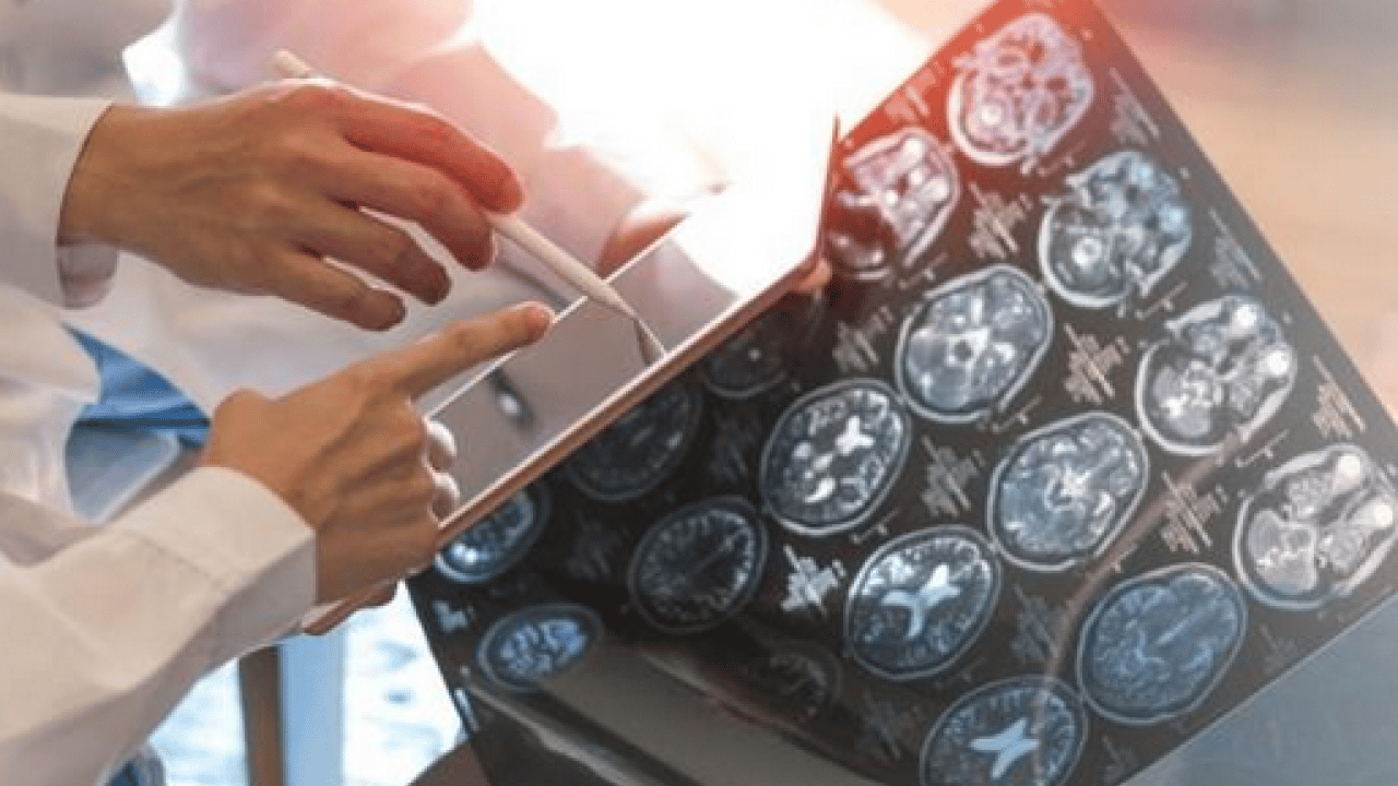 Foto - Beyin sağlığını için sessiz tehdit: Demans riskini artırıyor...