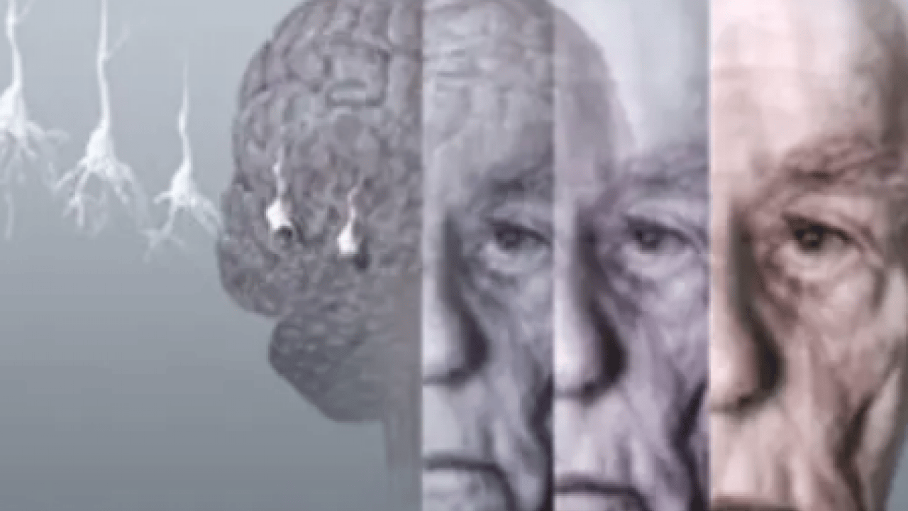 Foto - Beyin sağlığını korumada viral enfeksiyonlar... Alzheimer riskini 31 kat artırıyor! Dikkat Nörologlar açıkladı