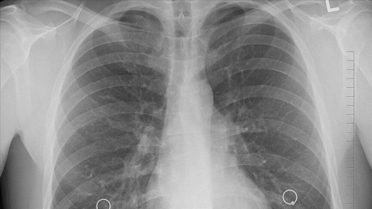 Foto - Bir nefeslik şifa: İç çekmek akciğerleri iyileştiriyor