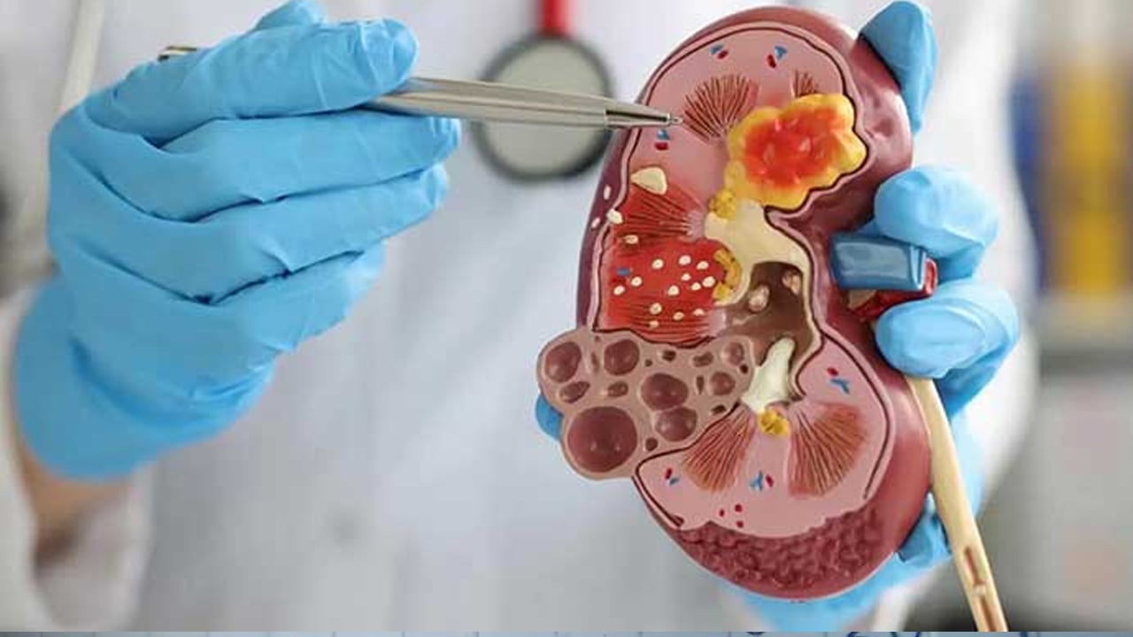 Foto - Böbreklerin doğal ilacı oymuş! Günde 1 bardak bile içseniz! Böbrek taşı rahatsızlığı için her gün tüketin