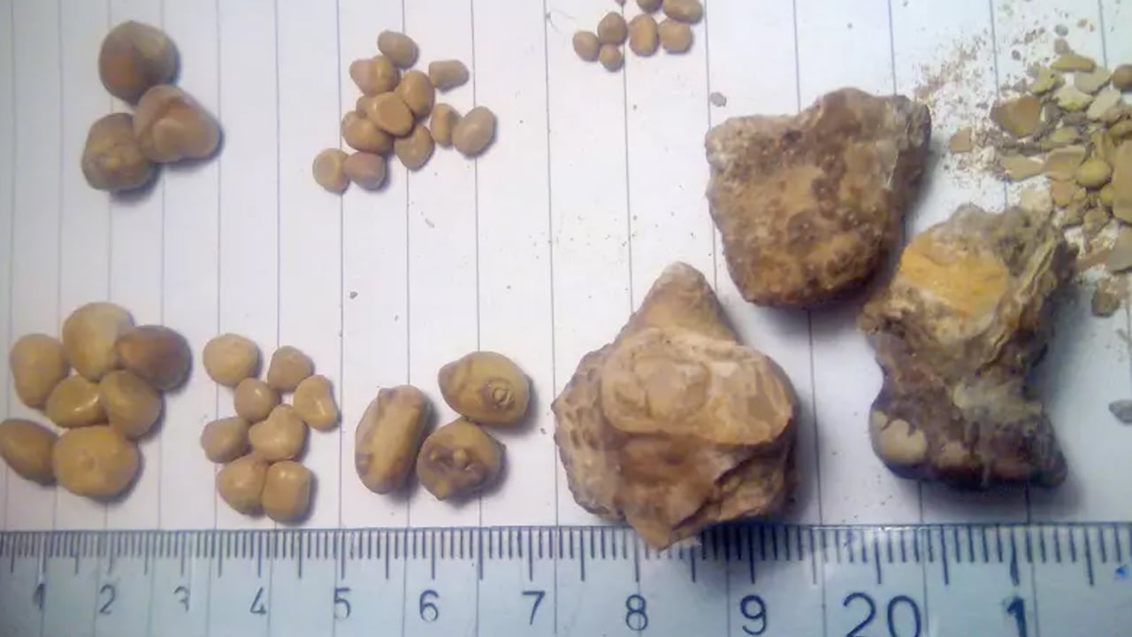 Foto - Böbreklerin doğal ilacı oymuş! Günde 1 bardak bile içseniz! Böbrek taşı rahatsızlığı için her gün tüketin