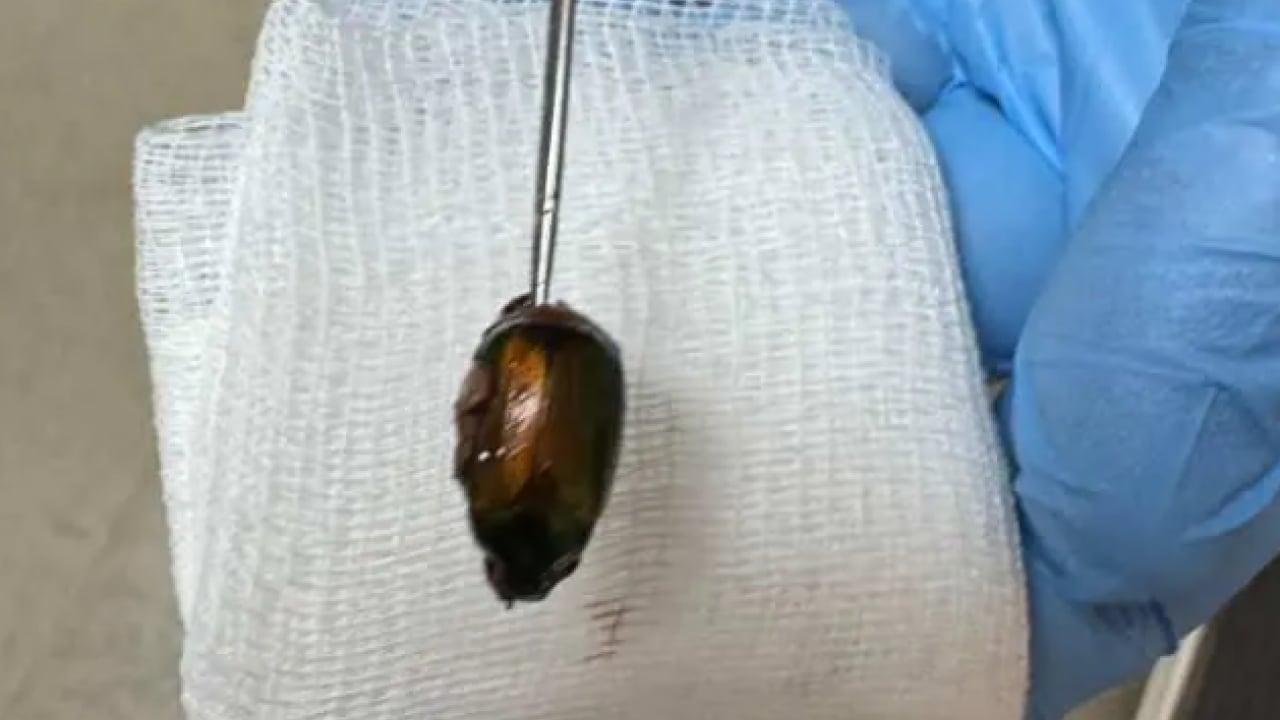 Foto - Baş ağrısı şikayetiyle doktora gitmişti: Kulağından çıkan şeye inanamadı!