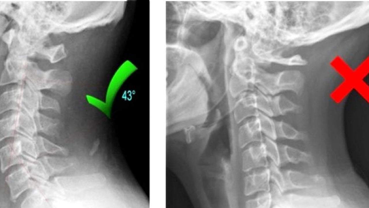 Foto - Boyun sağlığı ve boyun düzleşmesi için 7 tedavi seçeneği! En az 1'i yeter! İşte sırrı: Bakalım nasıl geçer?