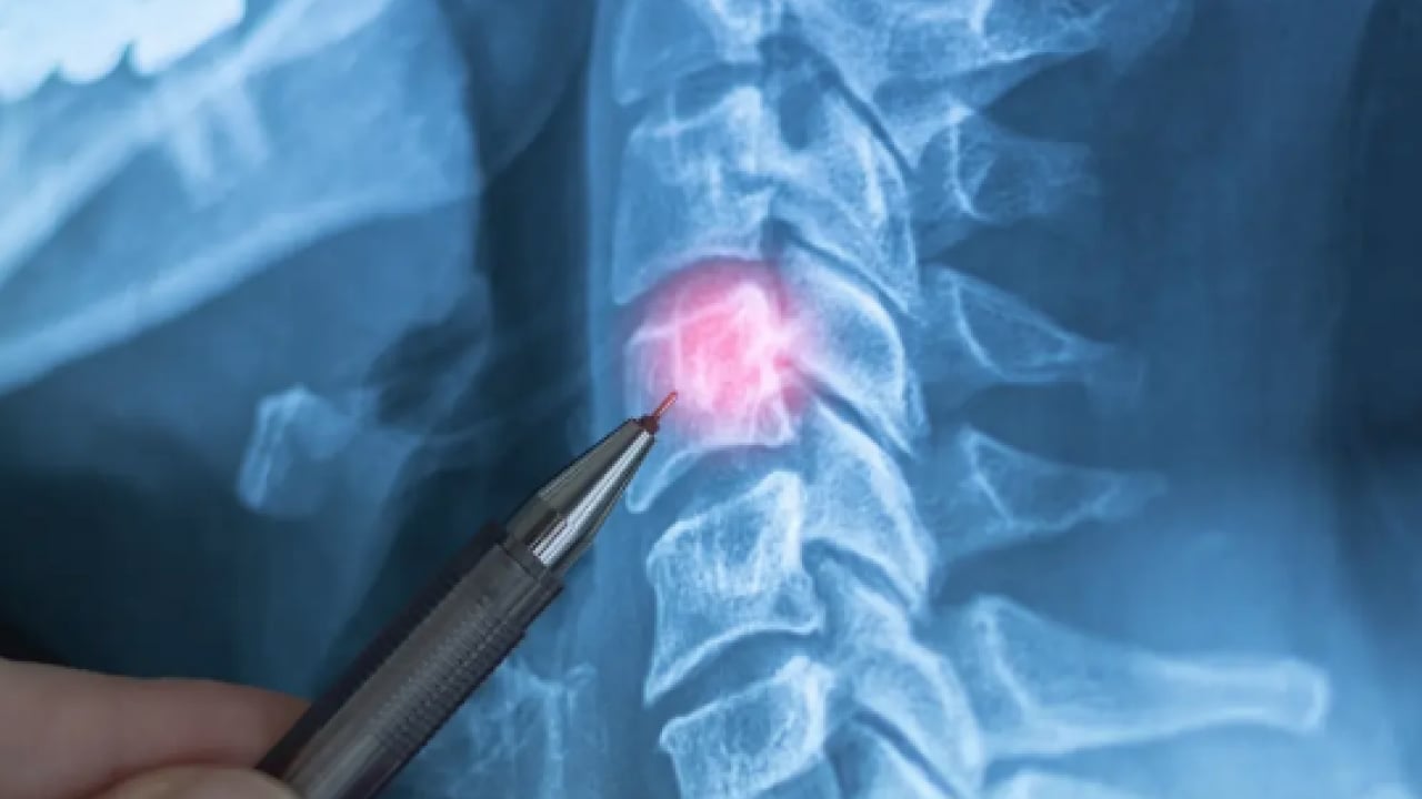 Foto - Boyun ve bel fıtığı neden olur? Uzmanından o hatalar fıtığı tetikliyor uyarısı