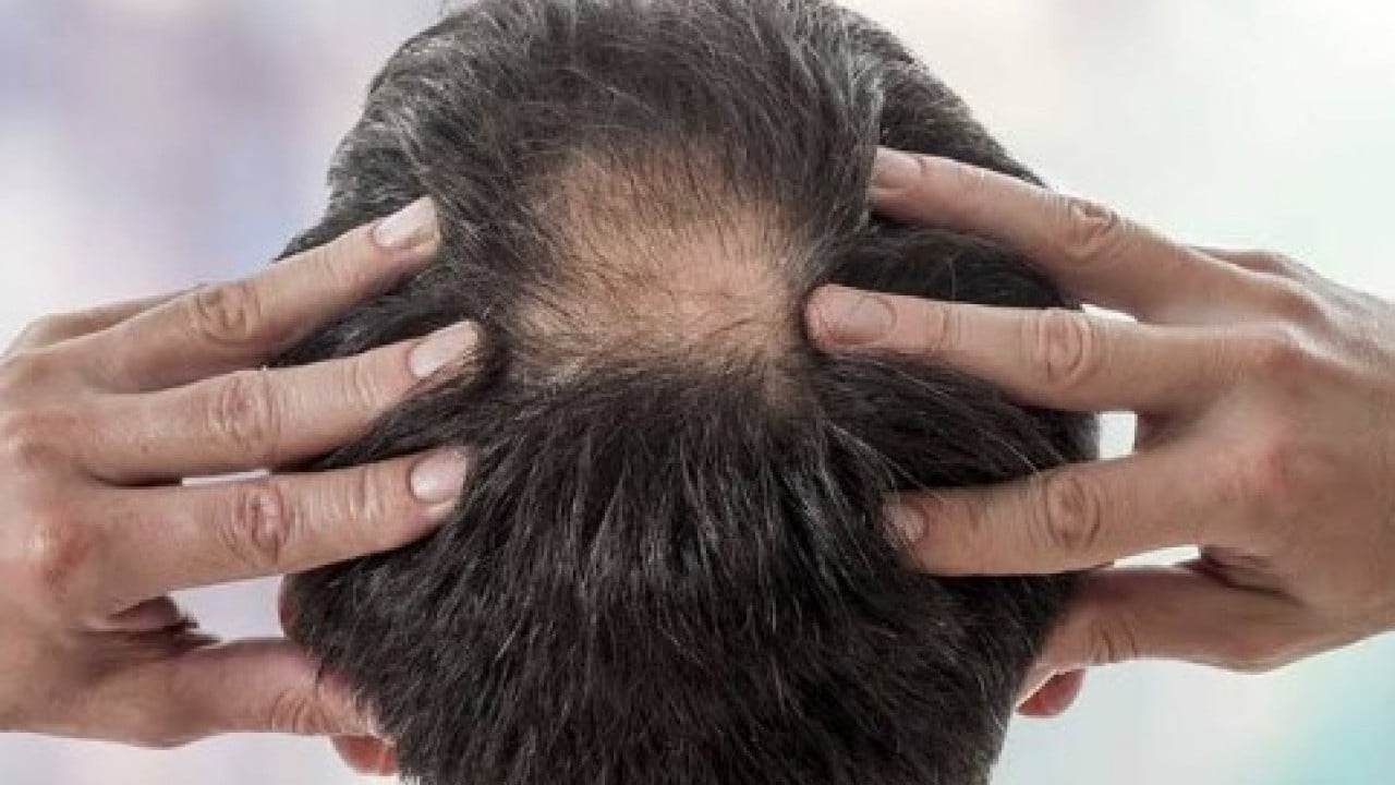 Bu doğallık diğerlerinden farklı! Saçlarda dökülmeyi önleyen 4 ev yapımı maske