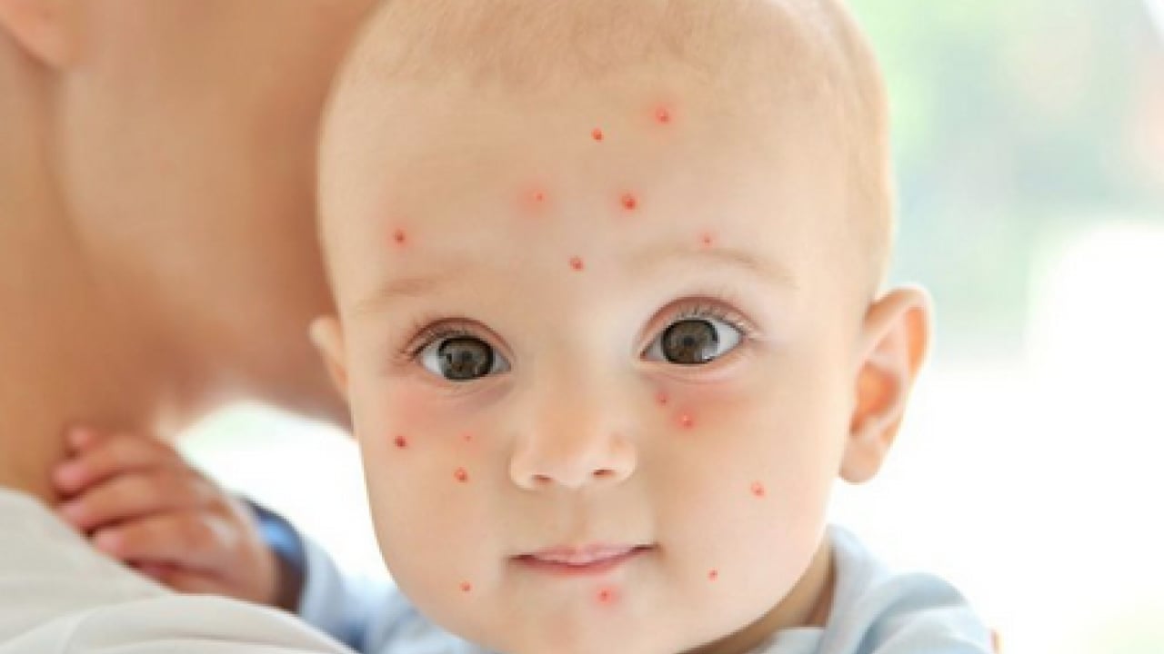 Foto - Bu enfeksiyona dikkat! Uzmanlardan suçiçeği uyarısı geldi! Öksürmek ve hapşırmak ile...