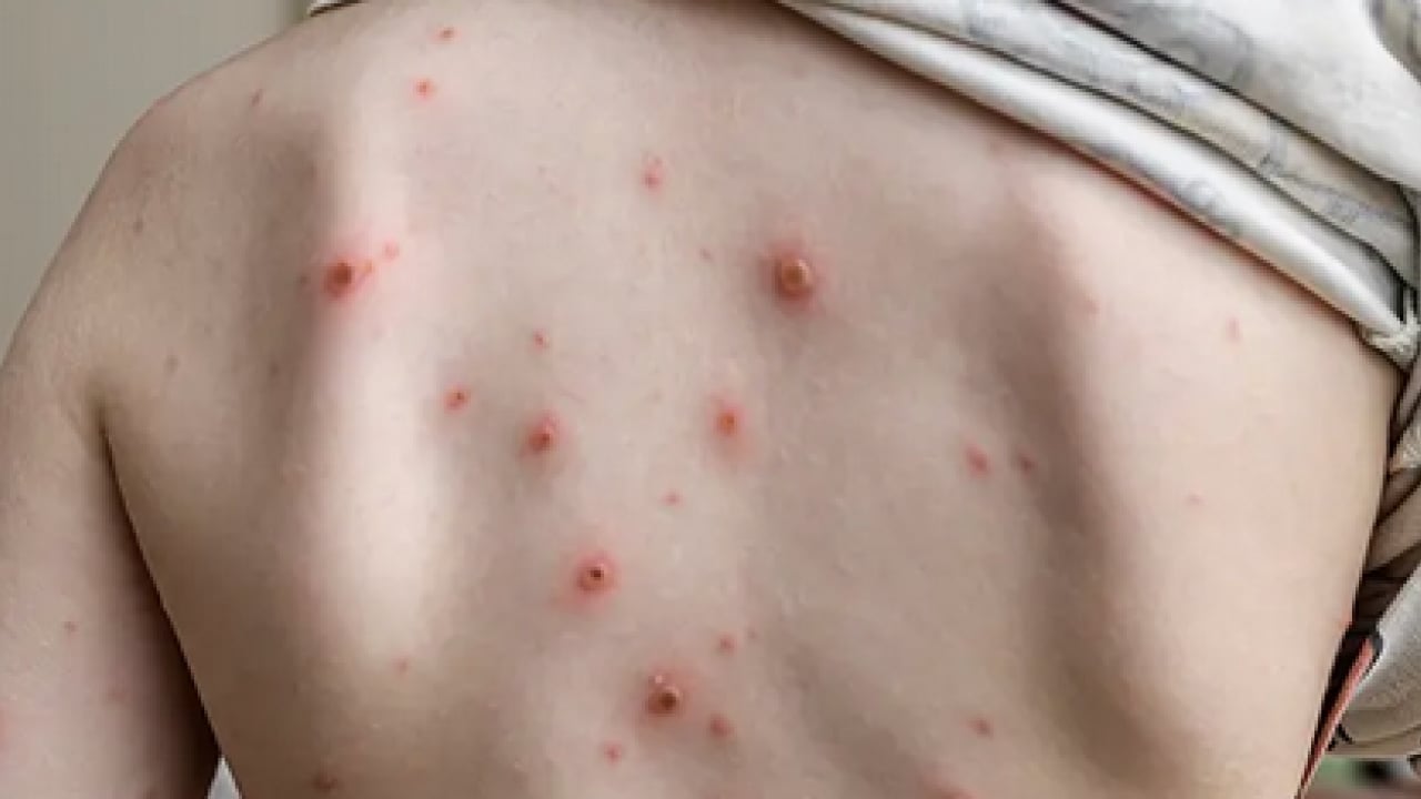 Foto - Bu enfeksiyona dikkat! Uzmanlardan suçiçeği uyarısı geldi! Öksürmek ve hapşırmak ile...