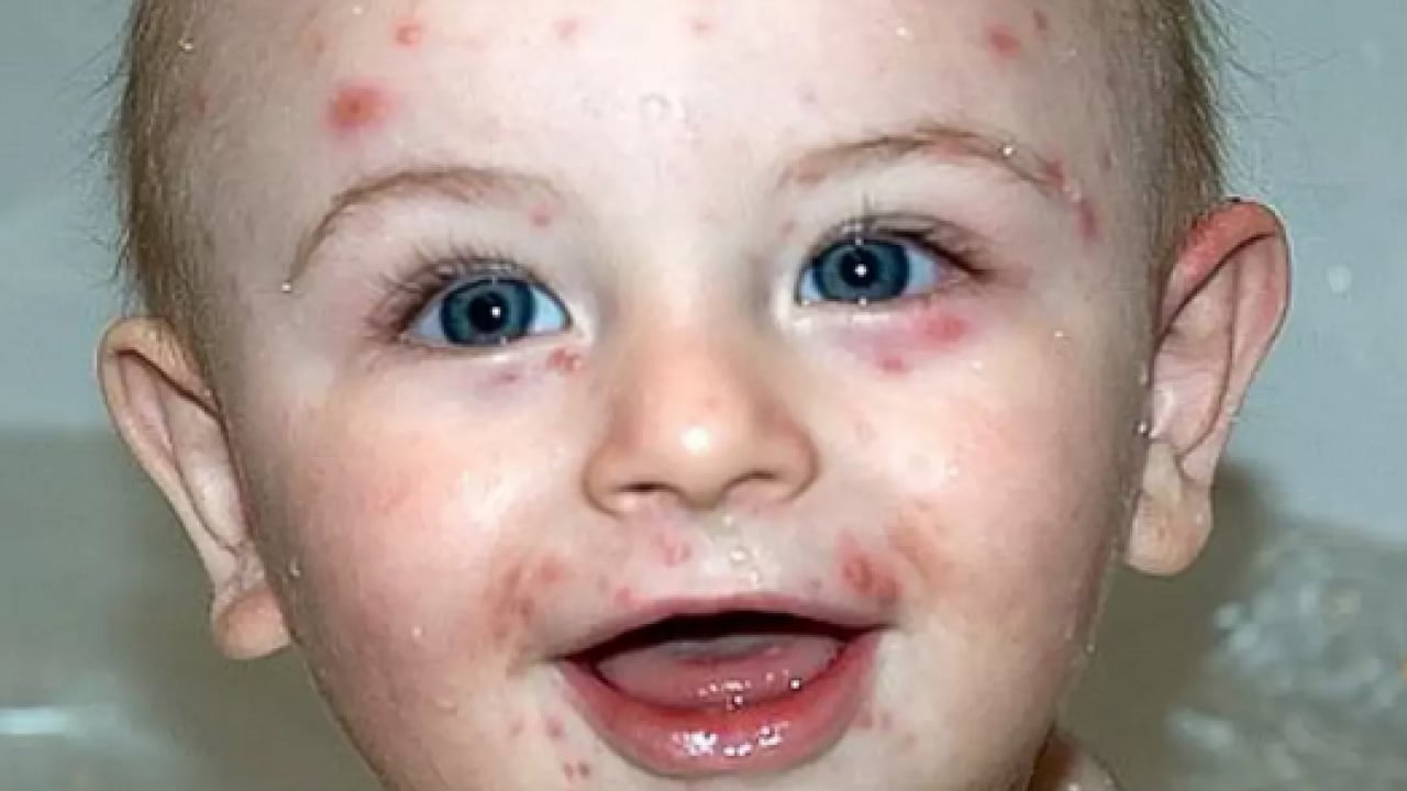 Bu enfeksiyona dikkat! Uzmanlardan suçiçeği uyarısı geldi! Öksürmek ve hapşırmak ile...