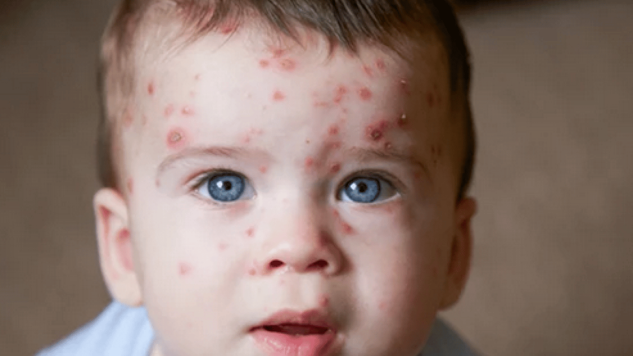 Foto - Bu enfeksiyona dikkat! Uzmanlardan suçiçeği uyarısı geldi! Öksürmek ve hapşırmak ile...