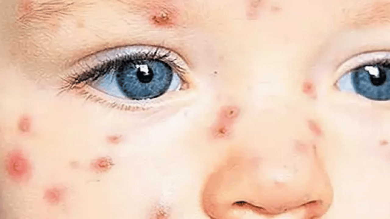 Foto - Bu enfeksiyona dikkat! Uzmanlardan suçiçeği uyarısı geldi! Öksürmek ve hapşırmak ile...