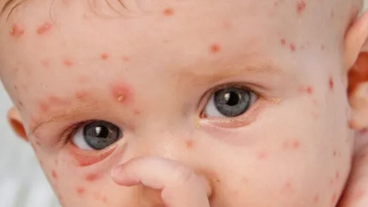 Foto - Bu enfeksiyona dikkat! Uzmanlardan suçiçeği uyarısı geldi! Öksürmek ve hapşırmak ile...