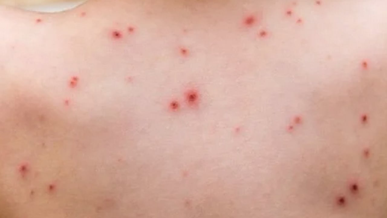 Foto - Bu enfeksiyona dikkat! Uzmanlardan suçiçeği uyarısı geldi! Öksürmek ve hapşırmak ile...