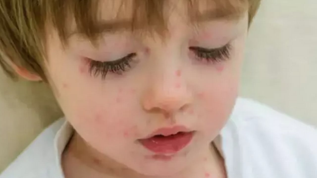 Foto - Bu enfeksiyona dikkat! Uzmanlardan suçiçeği uyarısı geldi! Öksürmek ve hapşırmak ile...