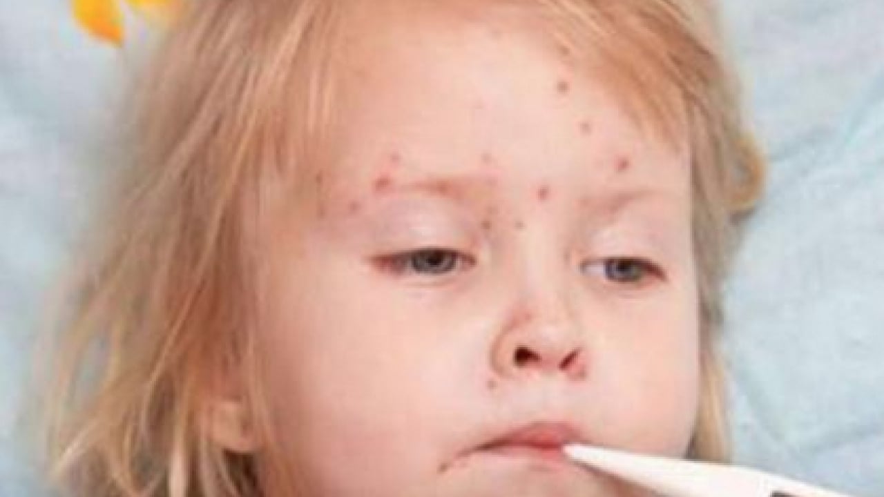 Foto - Bu enfeksiyona dikkat! Uzmanlardan suçiçeği uyarısı geldi! Öksürmek ve hapşırmak ile...