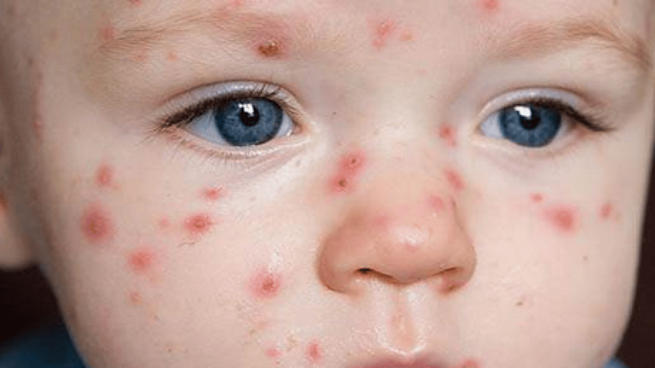 Foto - Bu enfeksiyona dikkat! Uzmanlardan suçiçeği uyarısı geldi! Öksürmek ve hapşırmak ile...