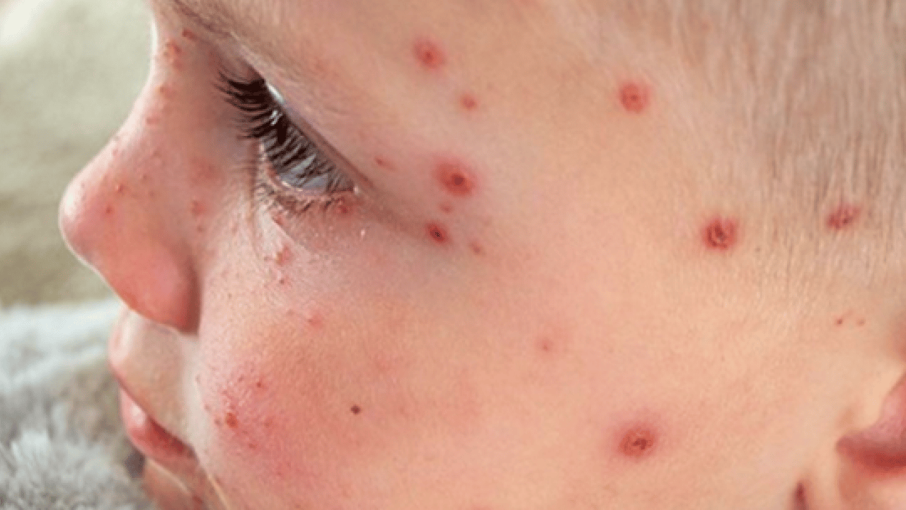 Foto - Bu enfeksiyona dikkat! Uzmanlardan suçiçeği uyarısı geldi! Öksürmek ve hapşırmak ile...