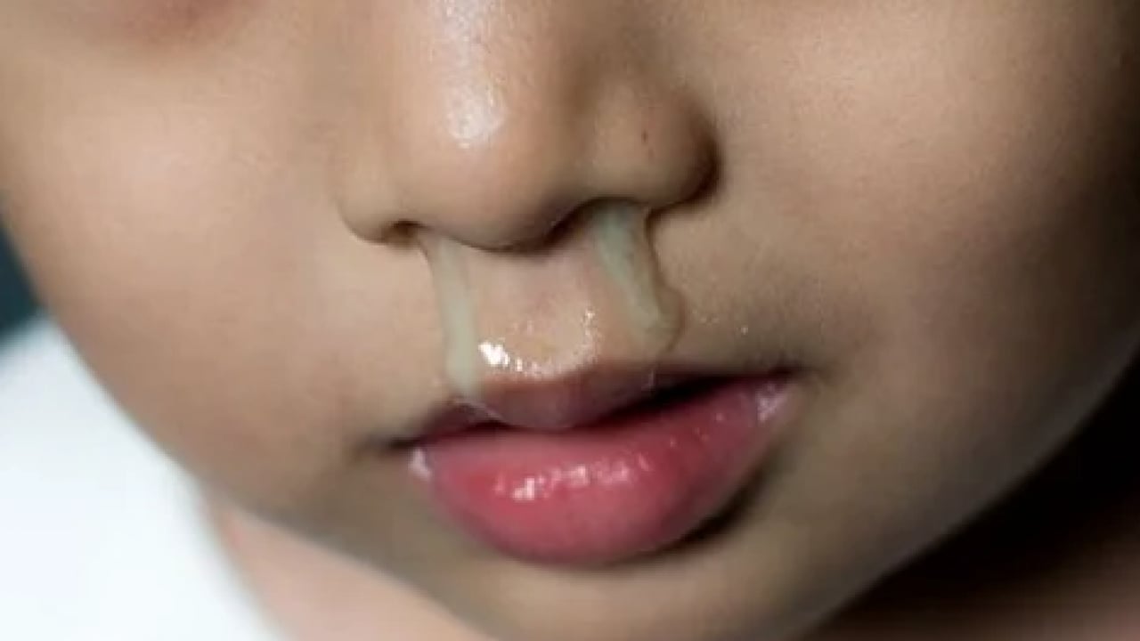 Foto - Bu haber olay olacak! Çocuklarda renkli burun akıntısı varsa doktora koşun...