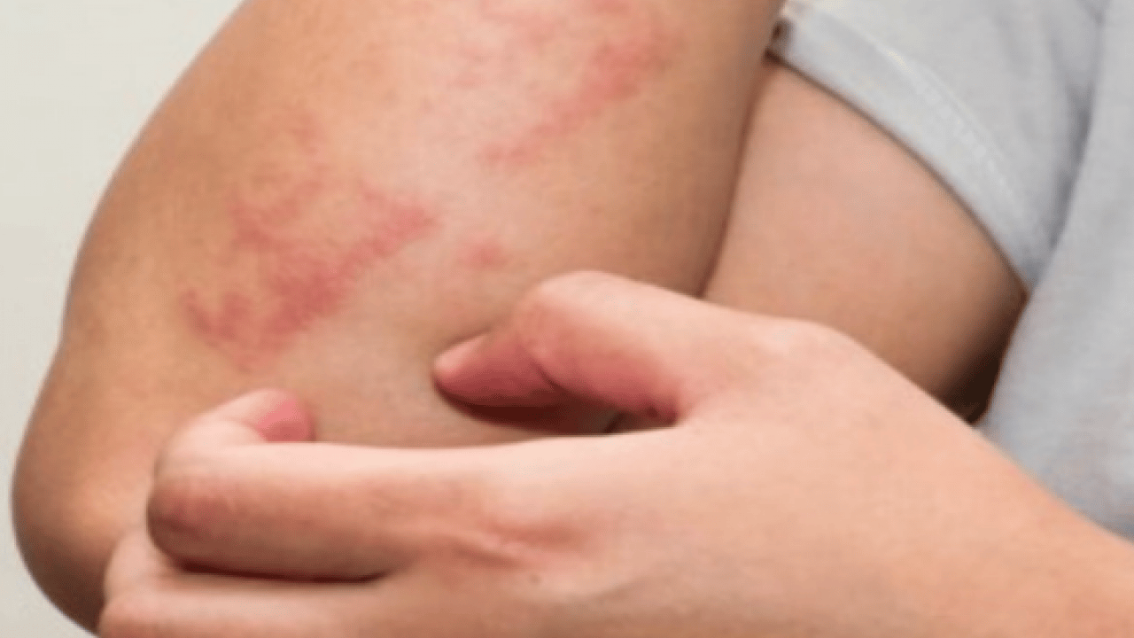 Foto - Bu hamleyi yapmalısınız: Alerjik rinit zamanla şiddetini azaltabilir ancak...