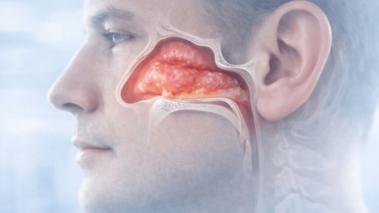 Foto - Bu hamleyi yapmalısınız: Alerjik rinit zamanla şiddetini azaltabilir ancak...