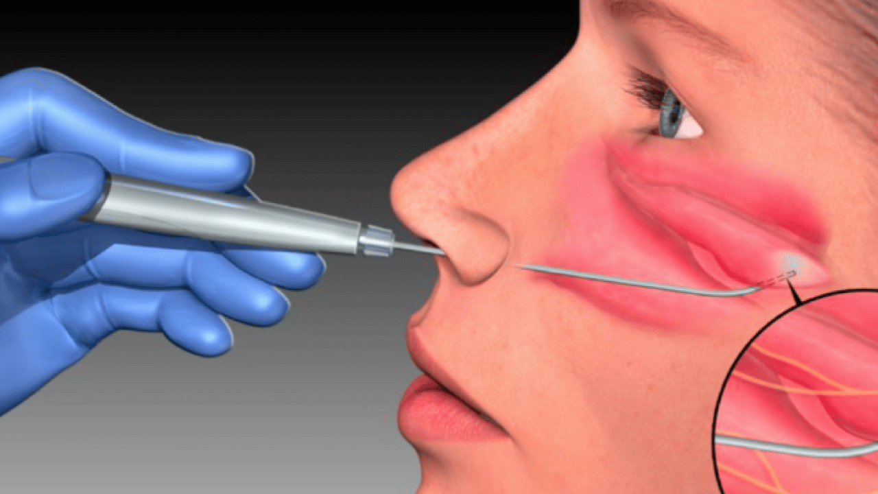 Foto - Bu hamleyi yapmalısınız: Alerjik rinit zamanla şiddetini azaltabilir ancak...