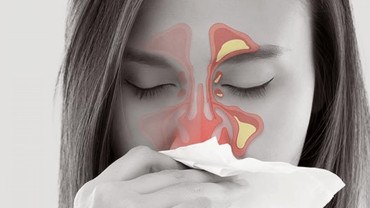 Foto - Bu hamleyi yapmalısınız: Alerjik rinit zamanla şiddetini azaltabilir ancak...