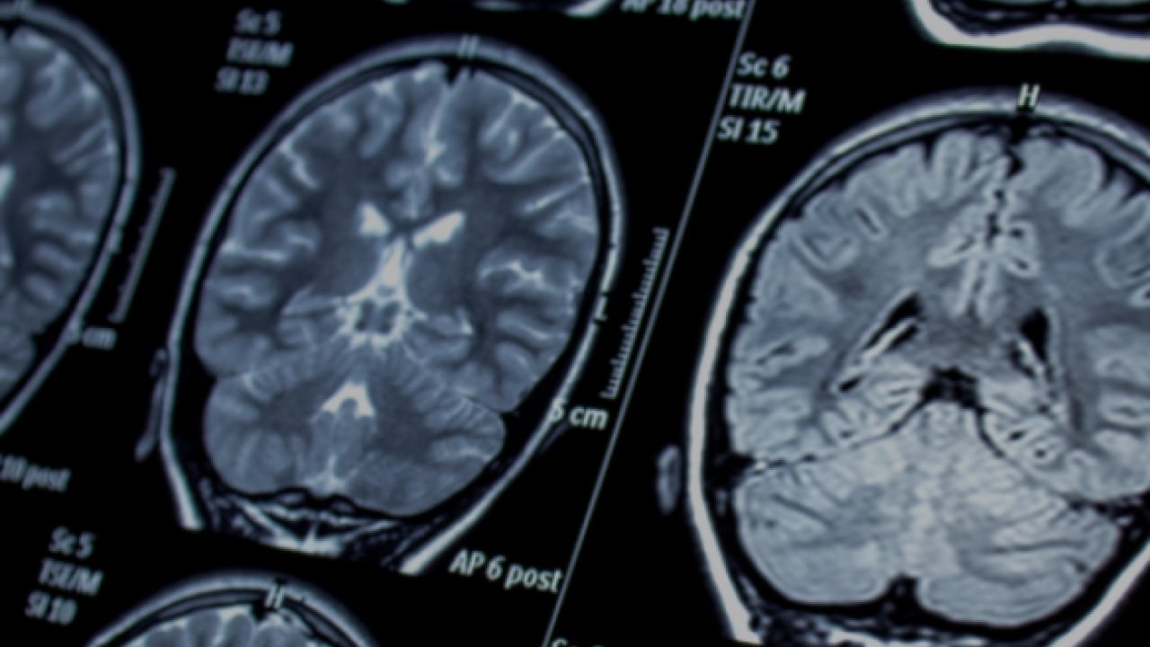 Foto - Bu hastalık detaylara doymuyor bir türlü ama... 'Epilepsi bulaşıcı bir hastalık değildir'