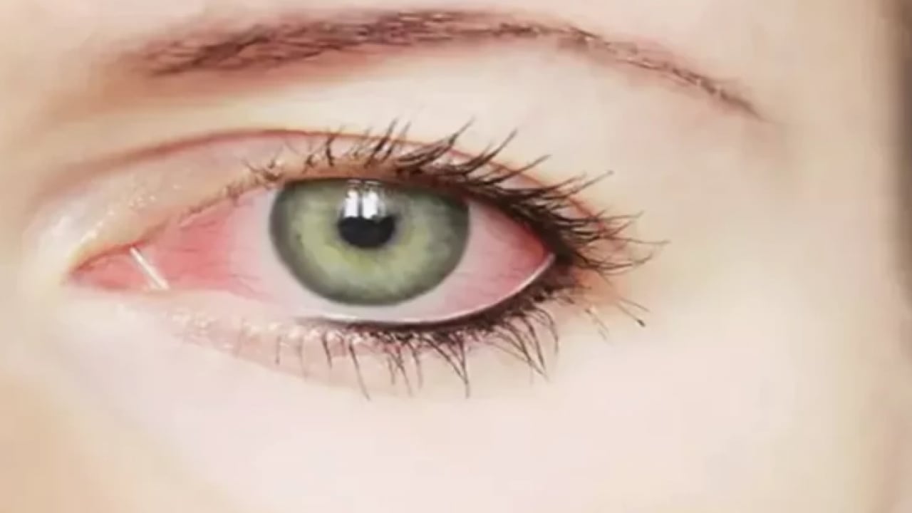 Foto - Herkes yorgunluk deyip geçiyor: Gözlerde kalıcı hasara neden olabilir!