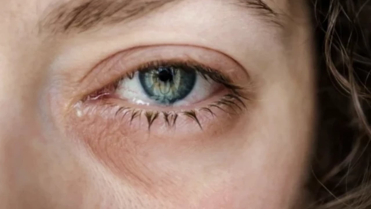 Foto - Herkes yorgunluk deyip geçiyor: Gözlerde kalıcı hasara neden olabilir!