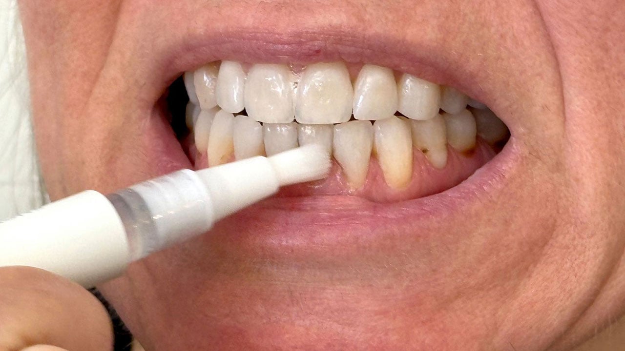 Bu ürünler dişleriniz için yıkım olabilir! Beyazlatıyor diye kullanılıyor, sonuç hüsran oluyor