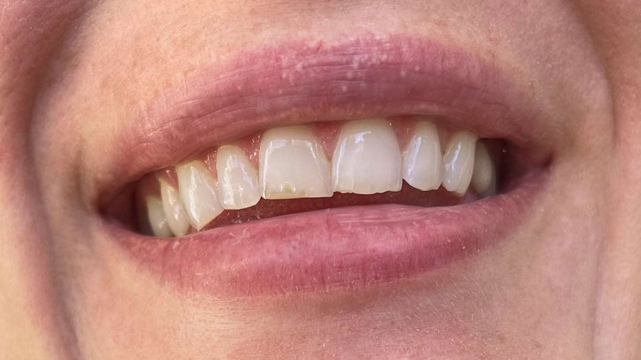 Foto - Bu ürünler dişleriniz için yıkım olabilir! Beyazlatıyor diye kullanılıyor, sonuç hüsran oluyor