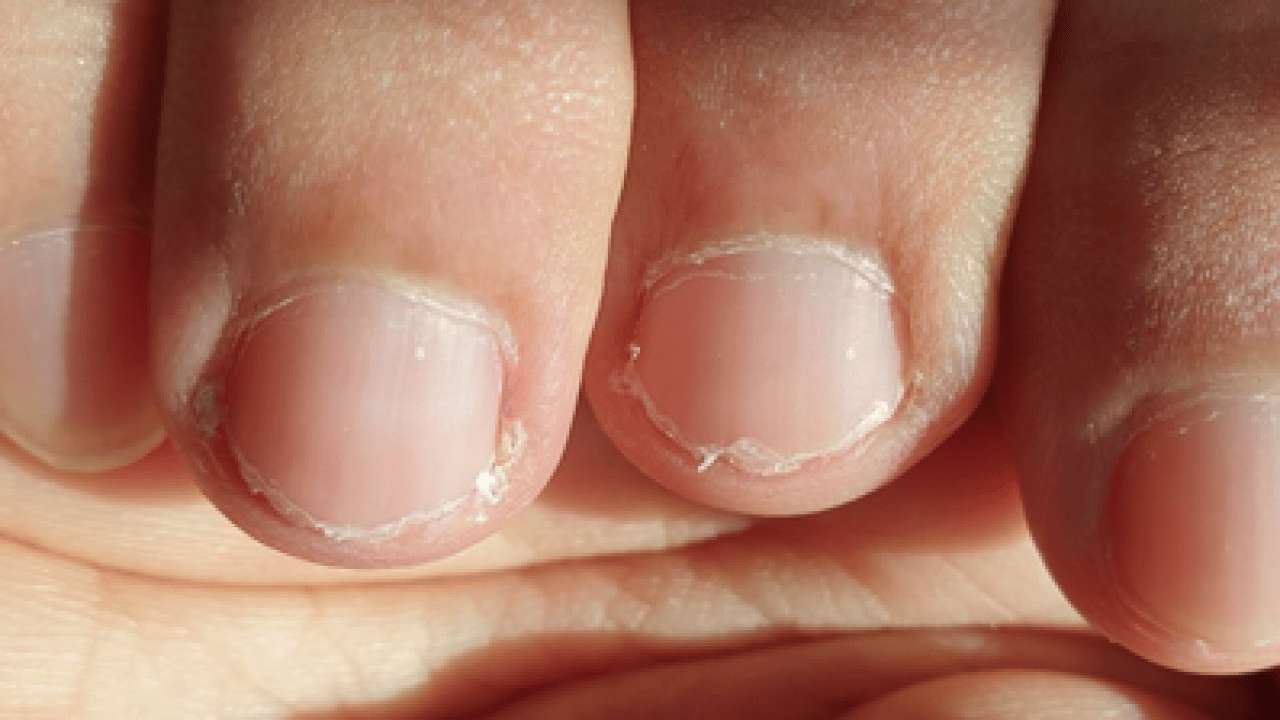 Bu uyarıya kulak verilmeli: Dalgalı tırnak bakın neyin habercisi! Vücut böyle alarm veriyor...