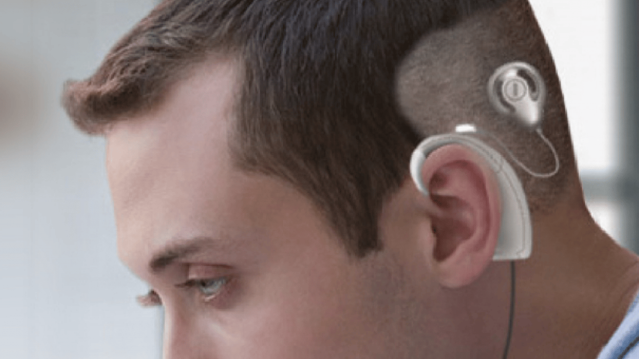 Foto - Bu yöntem ile tamamen duracak! Koklear İmplant ile bebekler de yaşlılar da duyabiliyor