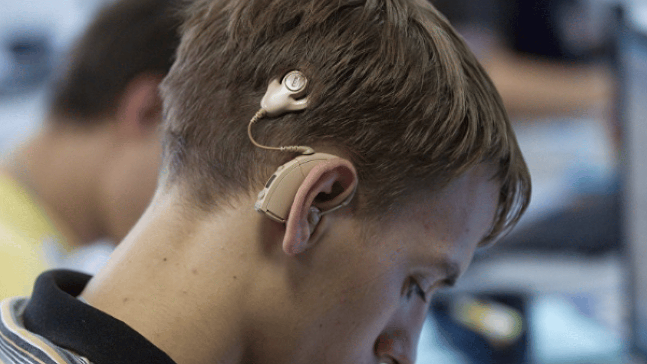 Foto - Bu yöntem ile tamamen duracak! Koklear İmplant ile bebekler de yaşlılar da duyabiliyor