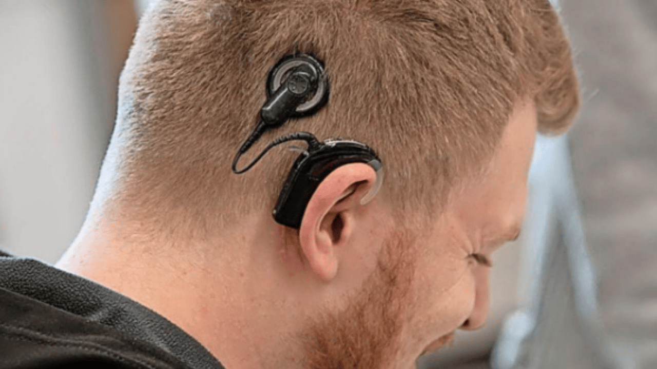 Foto - Bu yöntem ile tamamen duracak! Koklear İmplant ile bebekler de yaşlılar da duyabiliyor