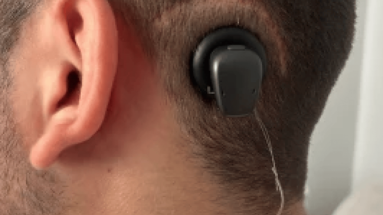 Foto - Bu yöntem ile tamamen duracak! Koklear İmplant ile bebekler de yaşlılar da duyabiliyor