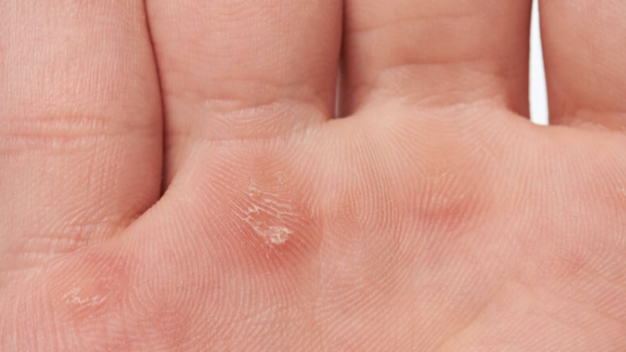 Foto - Bu yönteme kulak verin... Nasır acı veriyor mu? İşte evde uygulayabileceğiniz mucizevi çözümler