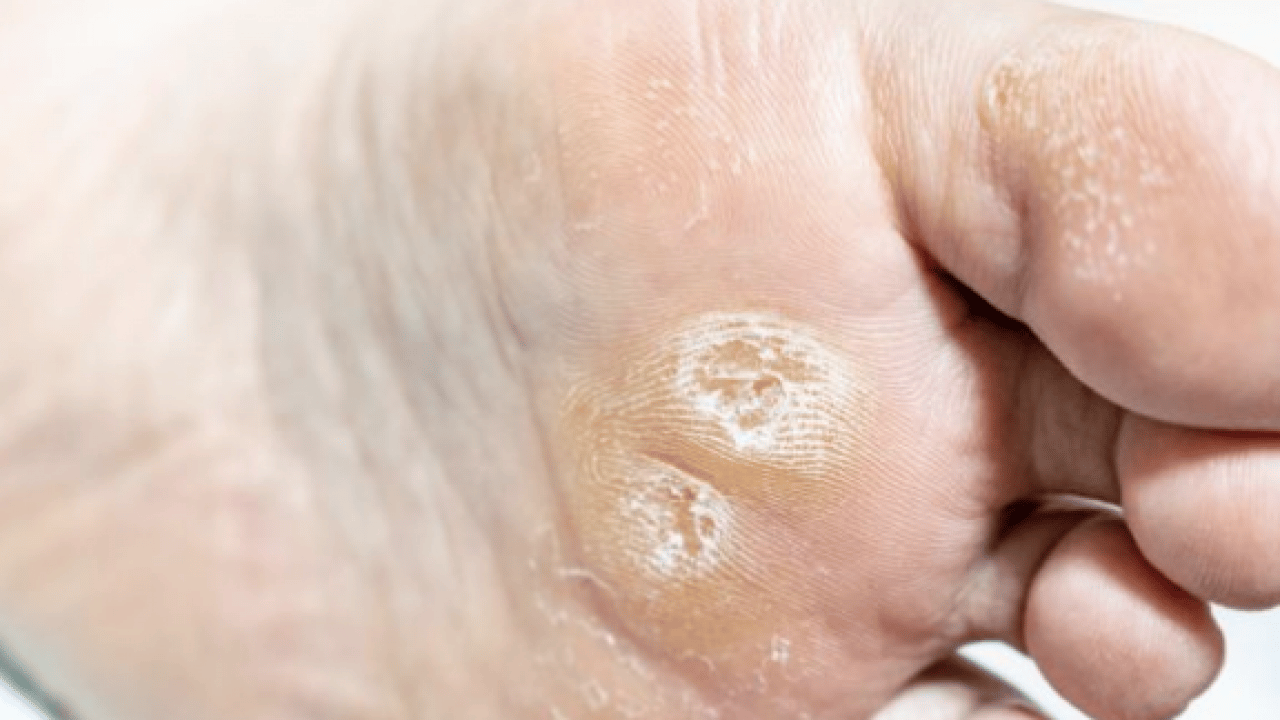 Foto - Bu yönteme kulak verin... Nasır acı veriyor mu? İşte evde uygulayabileceğiniz mucizevi çözümler