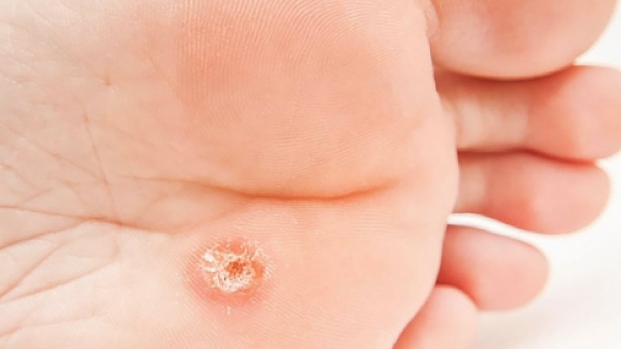 Foto - Bu yönteme kulak verin... Nasır acı veriyor mu? İşte evde uygulayabileceğiniz mucizevi çözümler