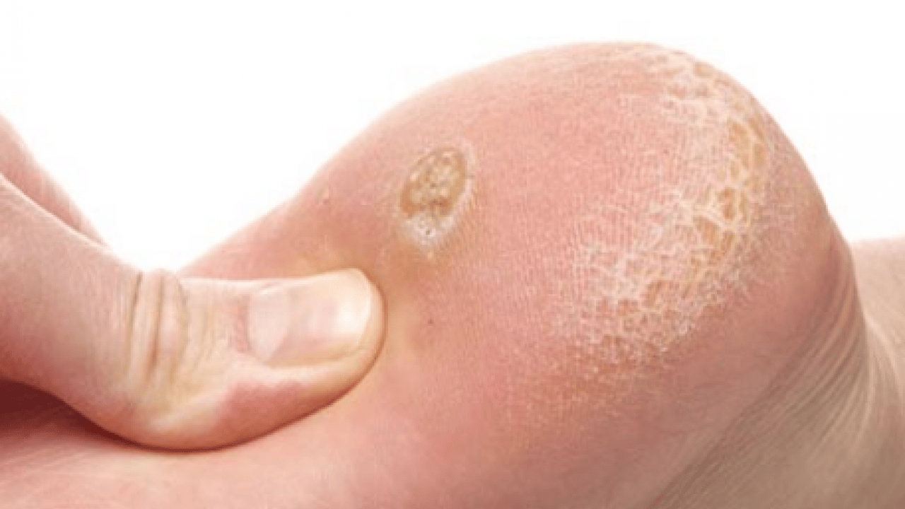 Bu yönteme kulak verin... Nasır acı veriyor mu? İşte evde uygulayabileceğiniz mucizevi çözümler