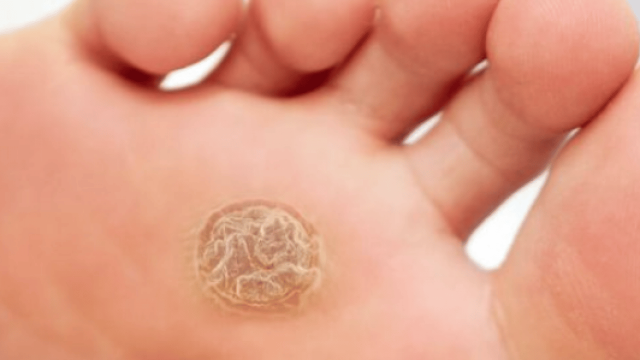 Foto - Bu yönteme kulak verin... Nasır acı veriyor mu? İşte evde uygulayabileceğiniz mucizevi çözümler