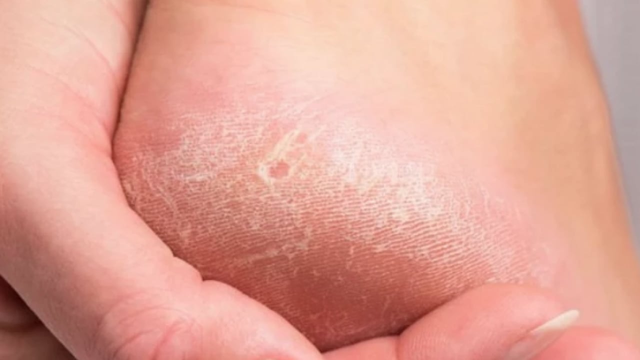 Foto - Bu yönteme kulak verin... Nasır acı veriyor mu? İşte evde uygulayabileceğiniz mucizevi çözümler