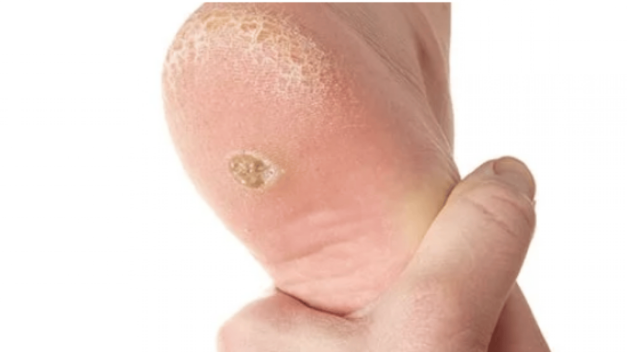 Foto - Bu yönteme kulak verin... Nasır acı veriyor mu? İşte evde uygulayabileceğiniz mucizevi çözümler