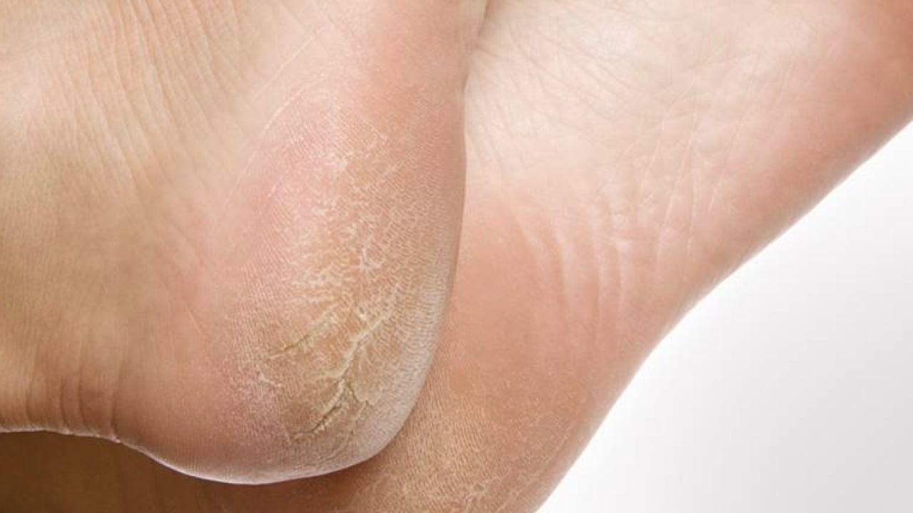 Foto - Bu yönteme kulak verin... Nasır acı veriyor mu? İşte evde uygulayabileceğiniz mucizevi çözümler