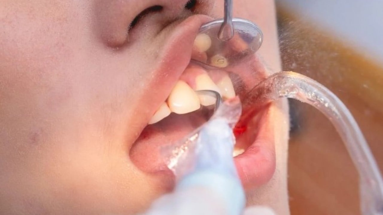 Foto - Bu yöntemle rahatlayacaksınız! İşte diş taşlarından kurtulmanın doğal yolu