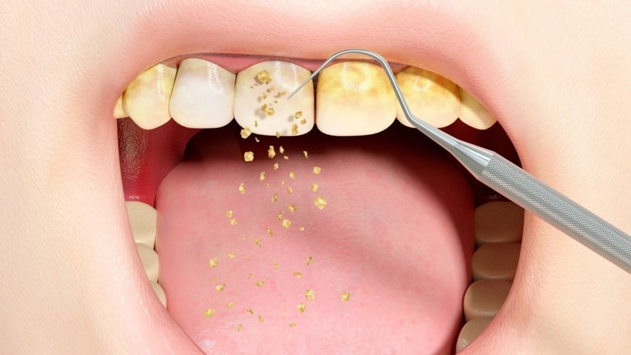 Bu yöntemle rahatlayacaksınız! İşte diş taşlarından kurtulmanın doğal yolu