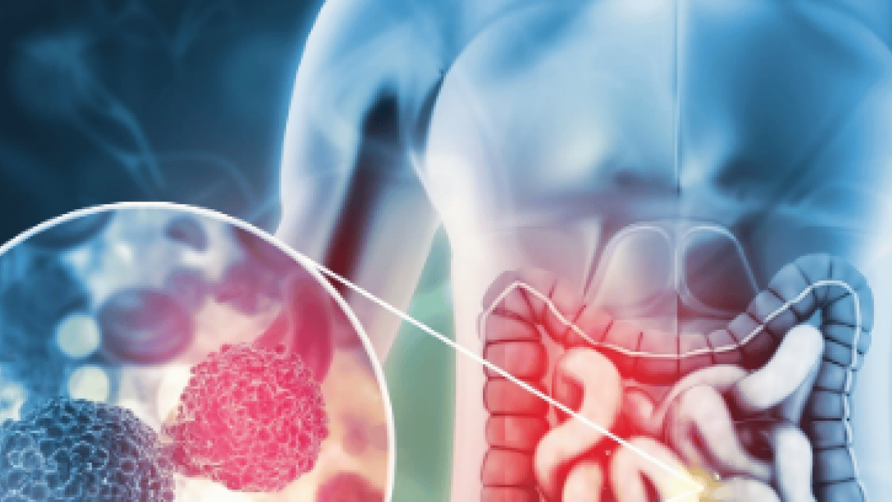 Foto - Bunları yapanlara kötü haber geldi: Kolon kanserinde erken tanı hayat kurtarıyor